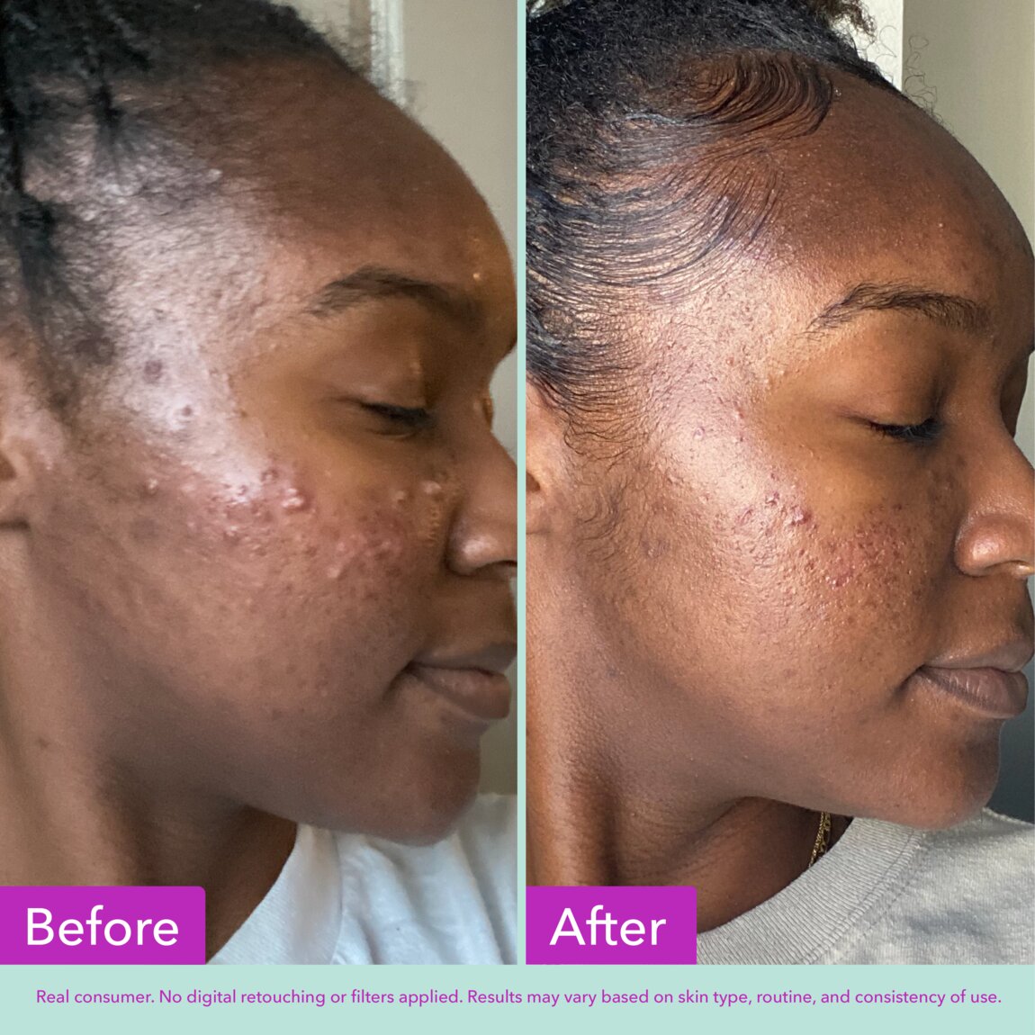 acne-foaming-cleanser-y3 zb_p.jpg